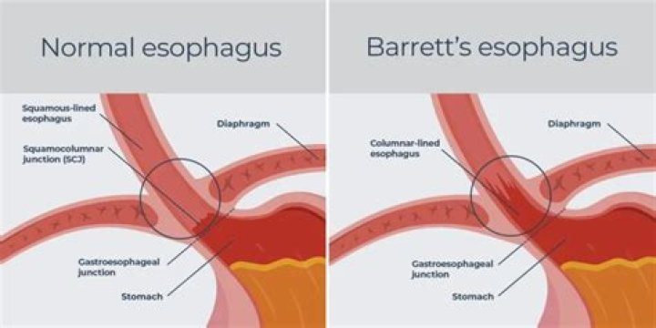 What is Barrett's stage c0 m1?