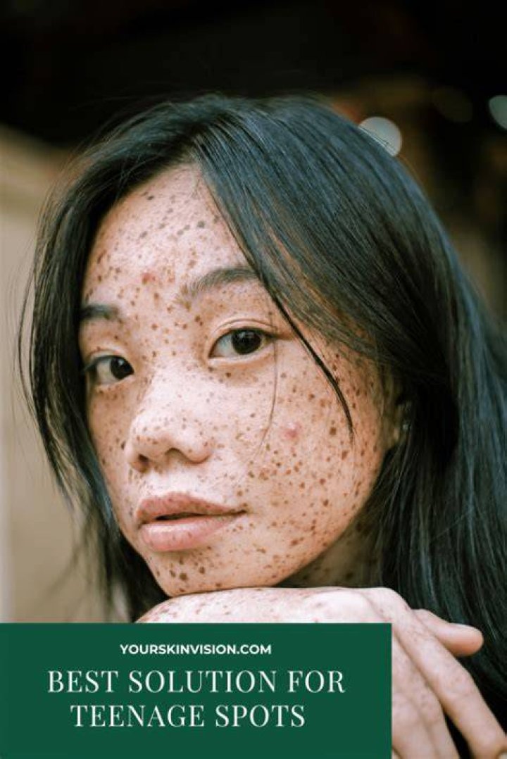 What is best for teenage spots?