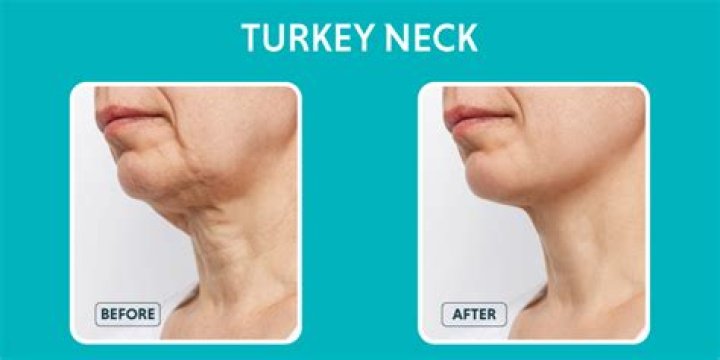 What is best treatment for turkey neck?