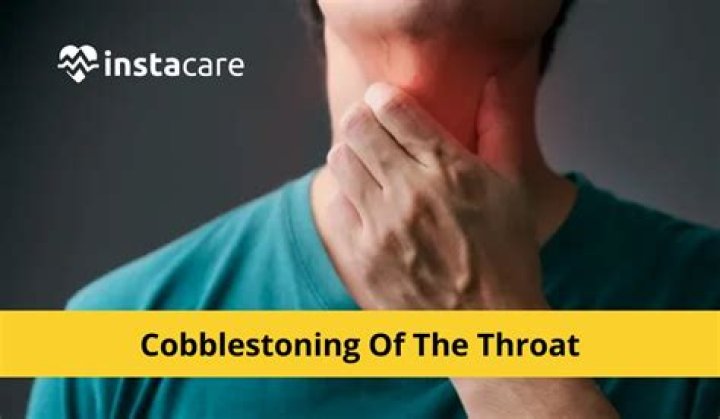 What is cobblestone throat?