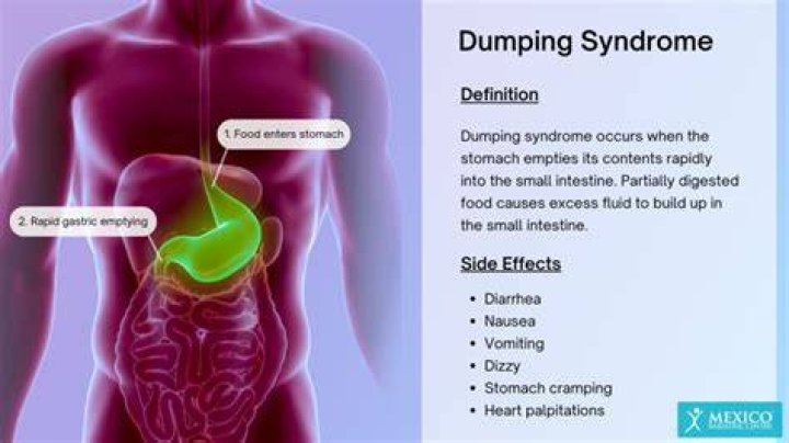 What is dumping syndrome after Whipple?