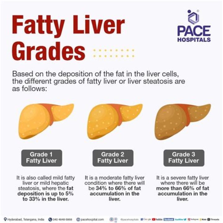 What is fatty liver grade 3?