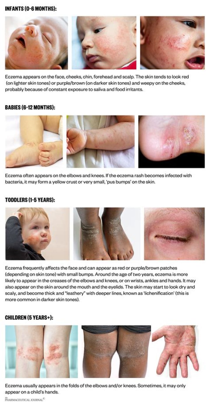 What is Karappan skin disease?