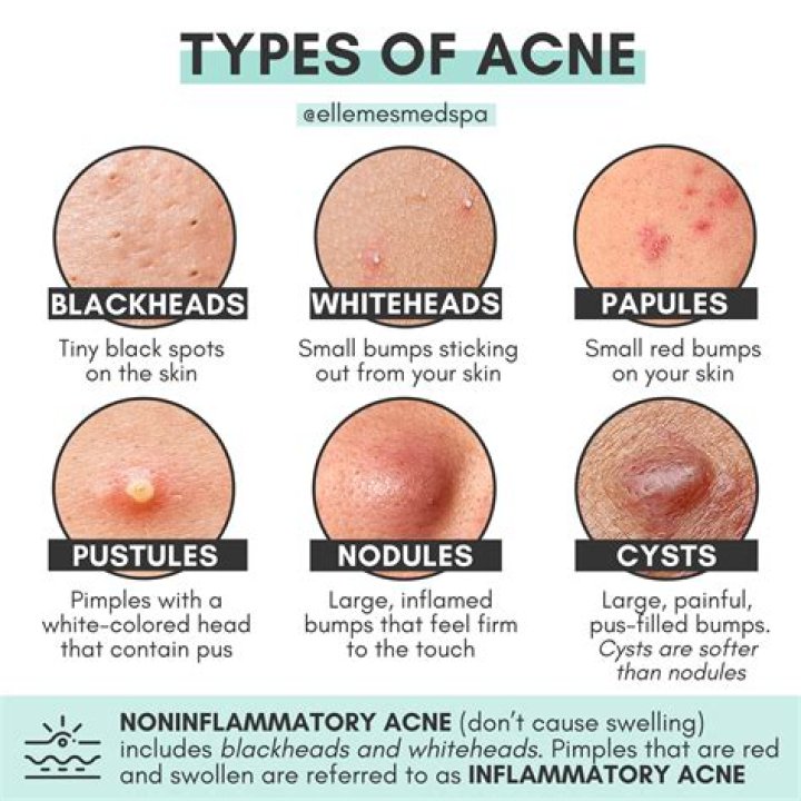 What is Pearl acne?