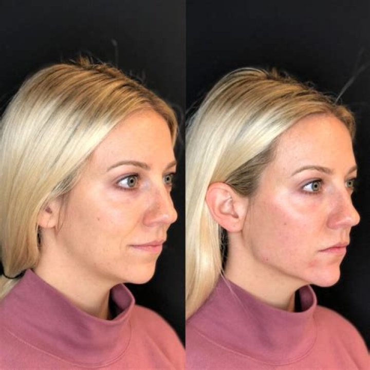 What is the best procedure to make your face look younger?