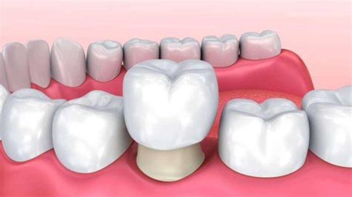 What is the difference between a cap and a crown on your teeth?