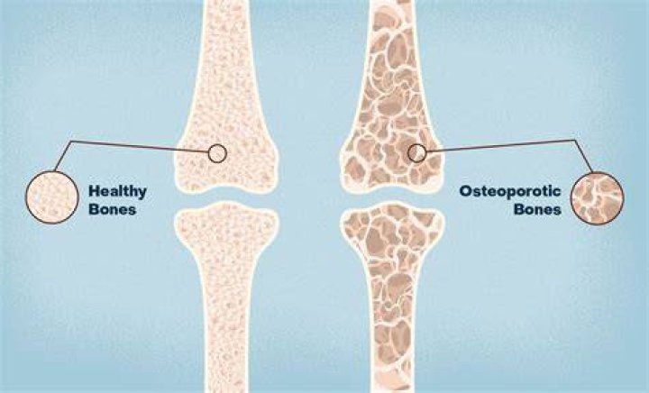 What is the most common bone disease?