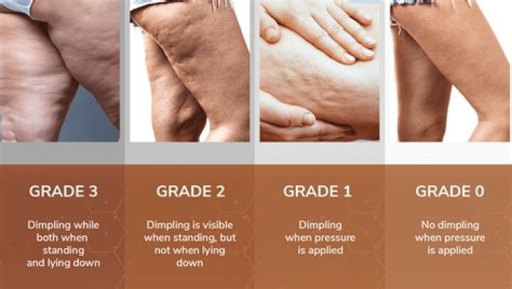 What is the most effective treatment for cellulite?