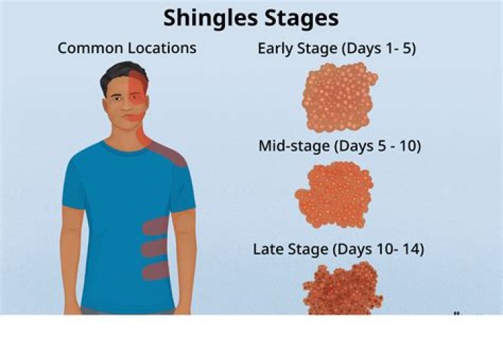 What is the most painful phase of shingles?
