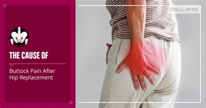 What is the rash between my buttocks?