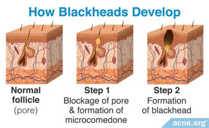 What is the white stuff that comes out of blackheads?
