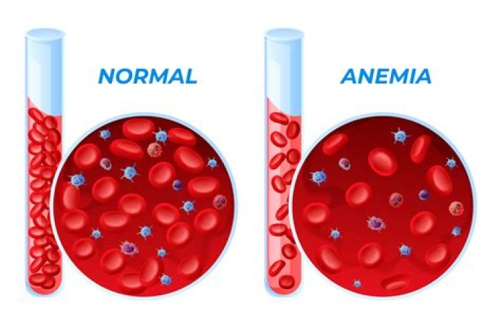 What it's like living with anemia?