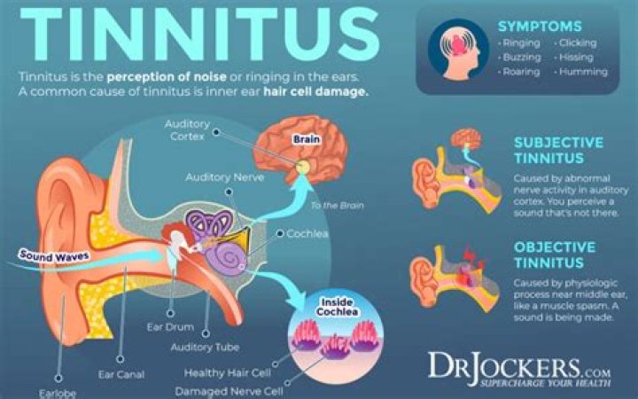 What kind of Dr do you see for tinnitus?