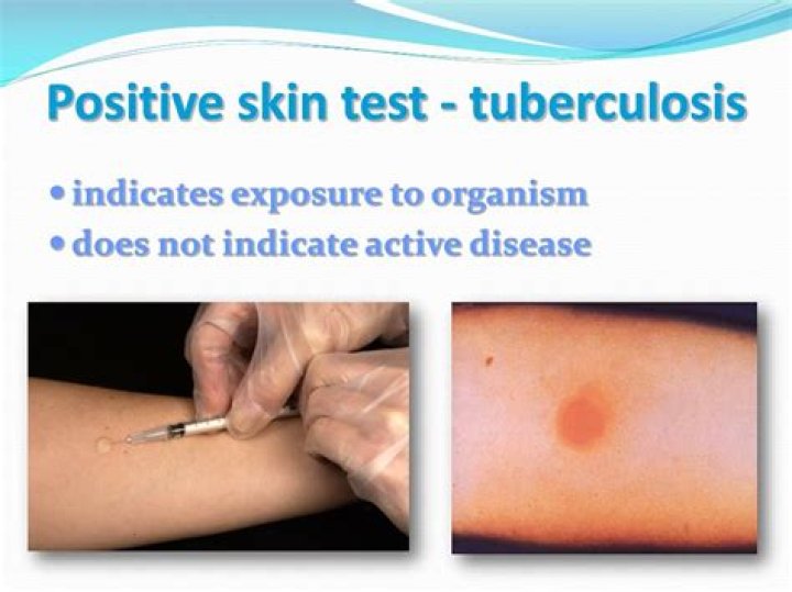 What size is a positive TB skin test?