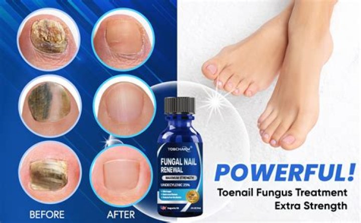 What supplement helps with fungus?