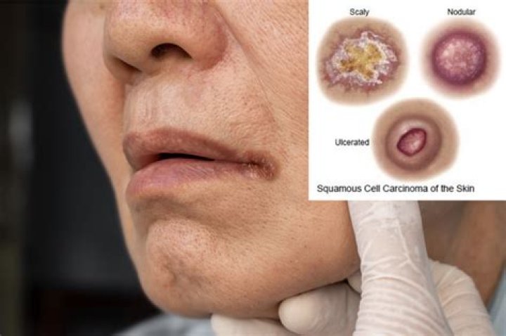 What virus causes squamous cell carcinoma?
