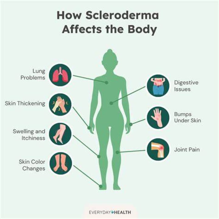 What were your first symptoms of scleroderma?