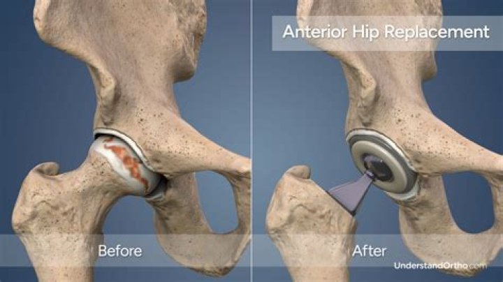 When can I bend more than 90 degrees after hip replacement?