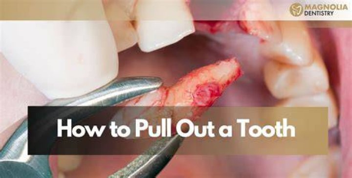 When does a dentist decide to pull a tooth?