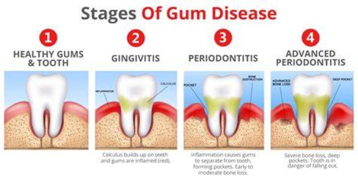 When does gingivitis become periodontitis?