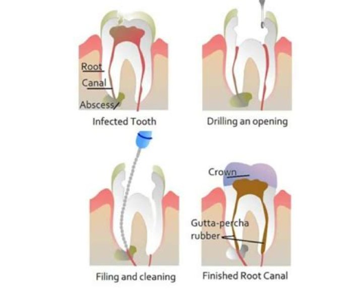 When is a root canal not possible?