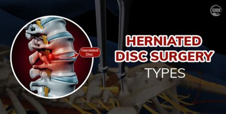 When should you have disc surgery?