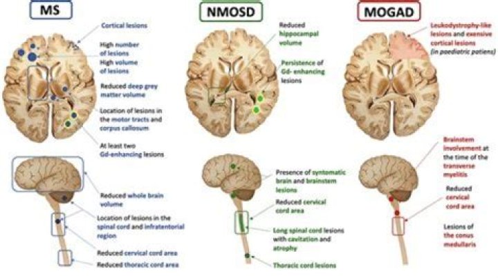 Where are most MS lesions found?