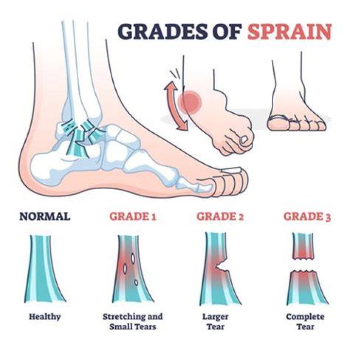 Which grade of sprain is most severe?