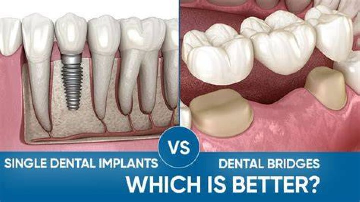 Which is better bridge or implant?