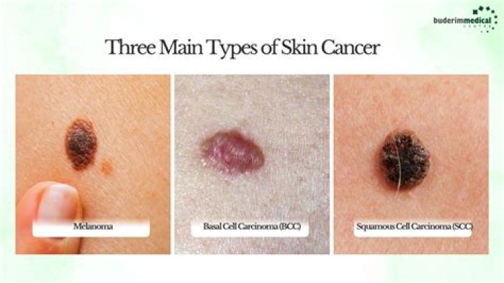Which is worse a BCC or SCC?