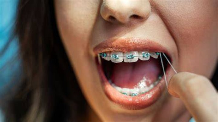 Who is the longest person to have braces?