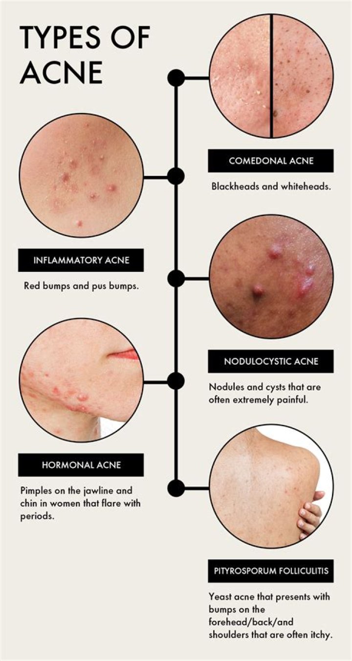 Who mostly gets acne?