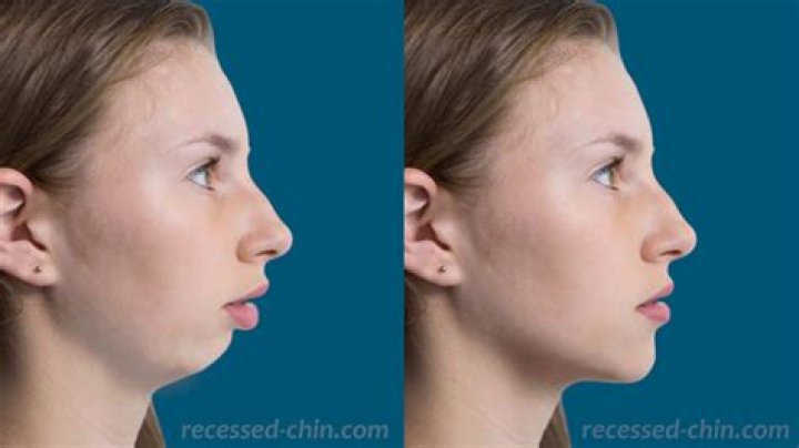 Why are babies chins recessed?