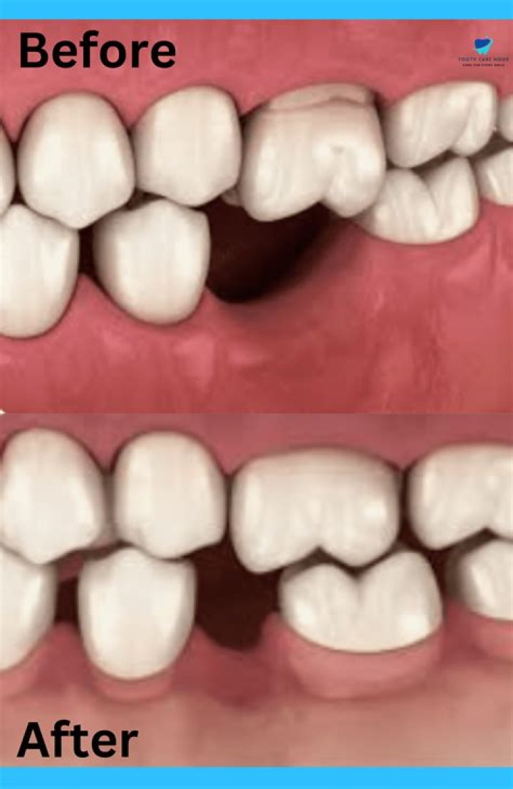 Why are my teeth separating as I get older?