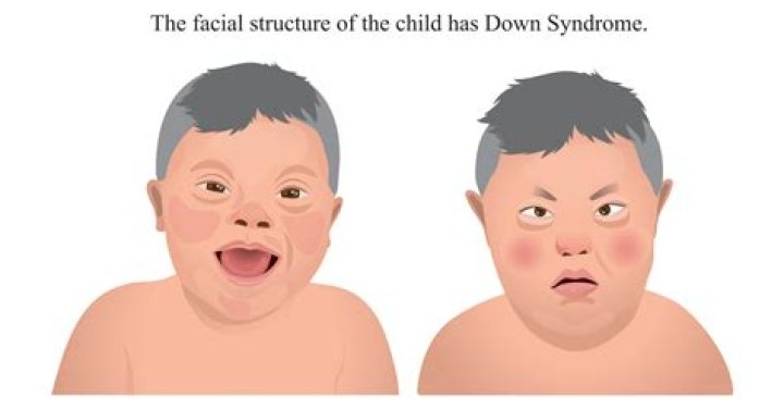 Why do babies get Down syndrome?