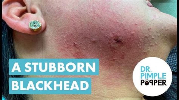 Why do blackheads turn green?