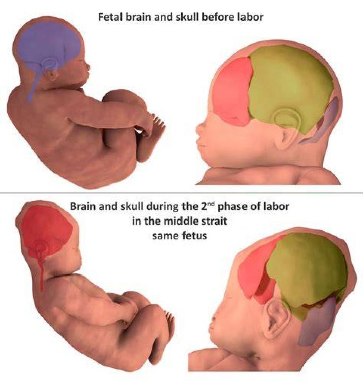 Why do C-section babies have more problems?