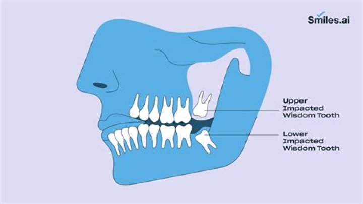 Why do humans have wisdom teeth that usually have to be removed?
