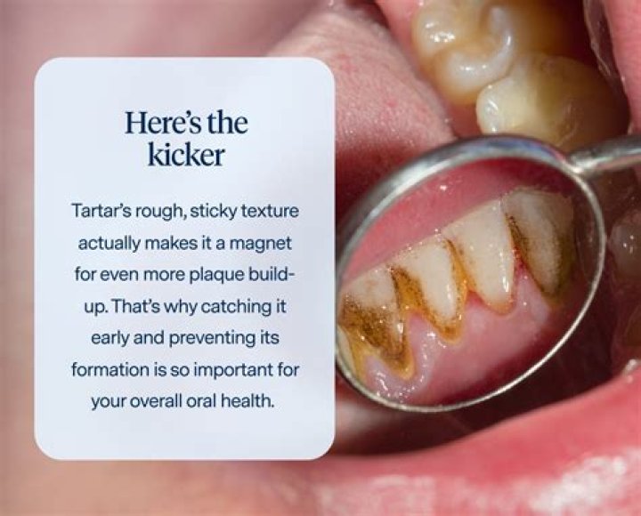 Why do I get so much tartar on my teeth?
