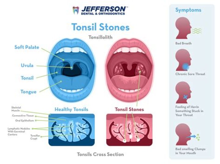 Why do I keep getting tonsil stones?