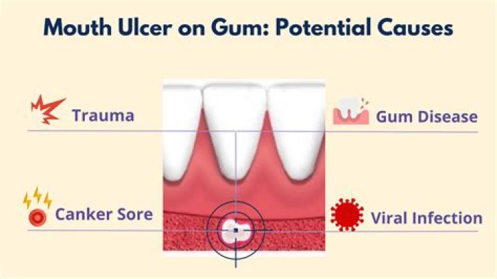 Why do my canine gums hurt?