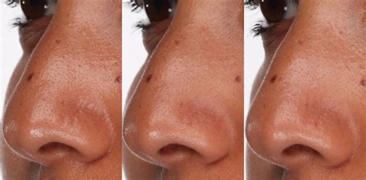 Why do my pores look black?