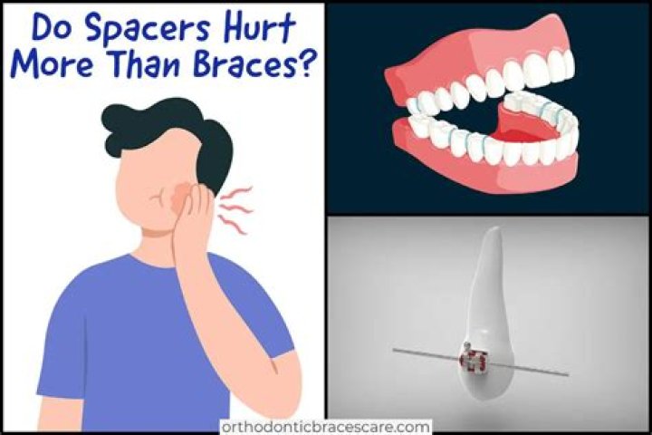 Why do spacers hurt so much?