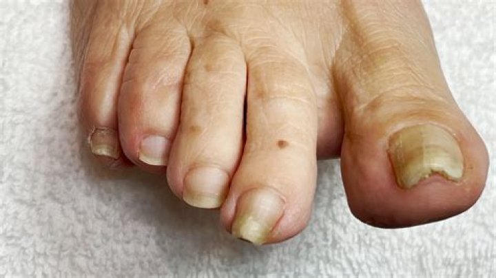 Why do toenails discolor with age?