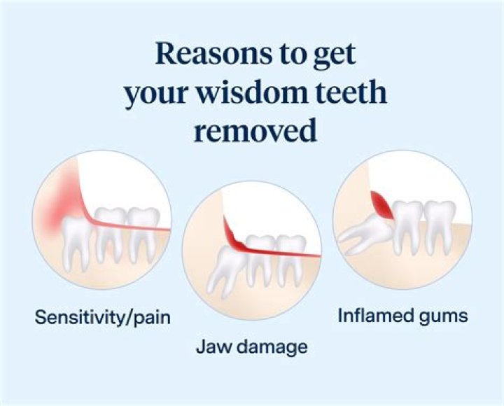 Why do wisdom teeth exist?