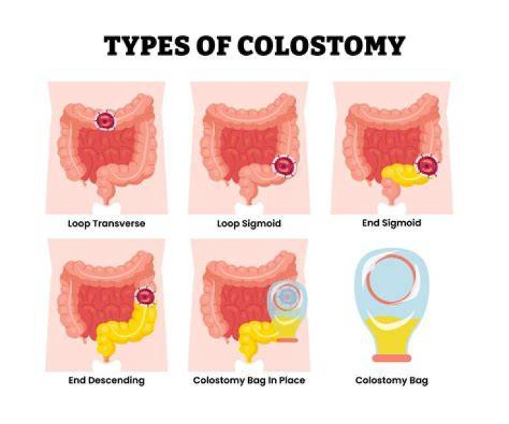 Why do you need a colostomy bag after surgery?