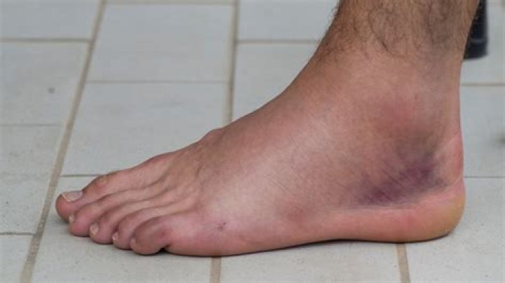 Why does a sprained ankle turn black and blue?