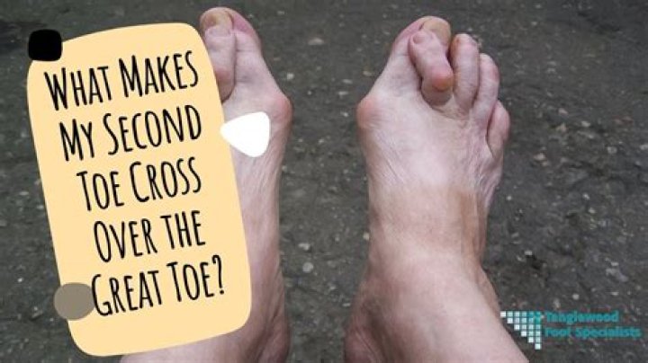 Why does my second toe overlap my big toe?