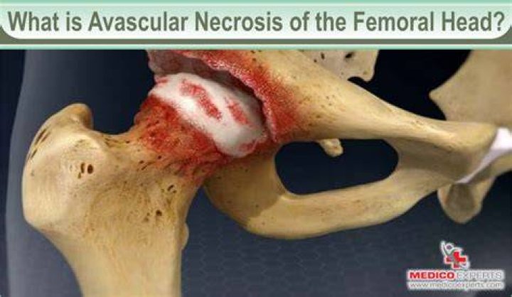 Why is femoral head prone to avascular necrosis?