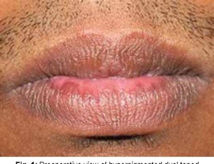 Why is my bottom lip turning pink?